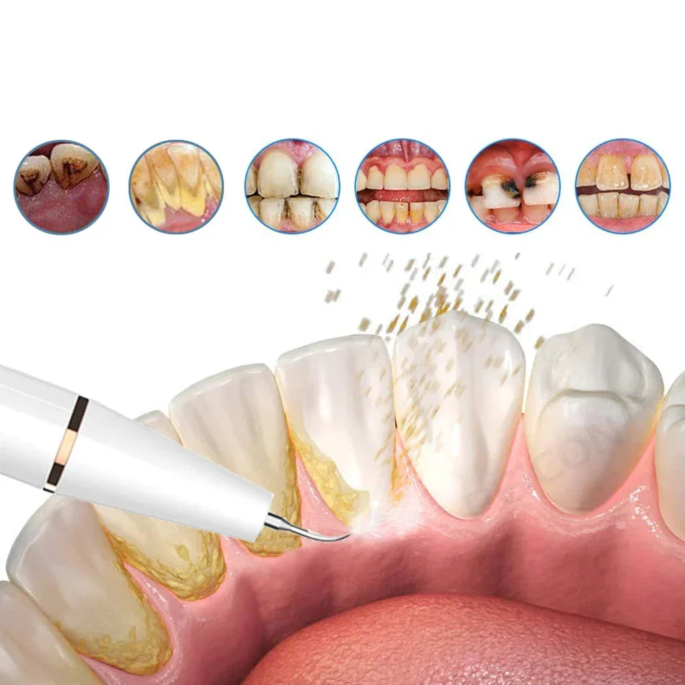 FreshSmile Pulitore Ultrasuoni per Denti – Per Denti Puliti e Sani