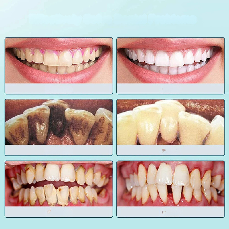 FreshSmile Pulitore Ultrasuoni per Denti – Per Denti Puliti e Sani